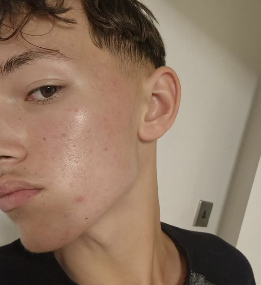 Skin after